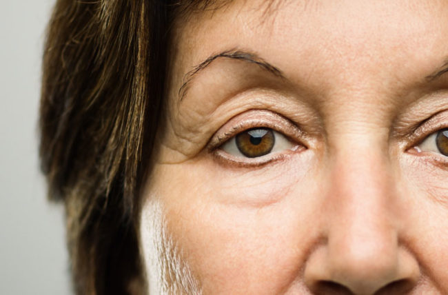 How To Prevent Droopy Eyelids From Botox